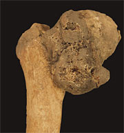 Femur tumor